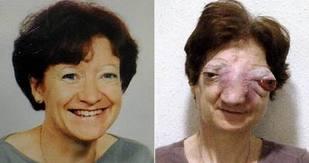 tumeur de la face, insolite, rare, Chantal Sébire, médiatisation, souffrances, décès, sinus, cloison nasale, l’euthanasie, esthésioneuroblastome,