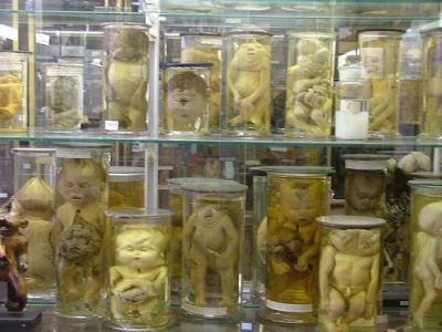 musée Dupuytren, insolite, Paris, faculté de médecine, anatomie pathologique, chirurgien, conservateur, collections, médecine opératoire, pièces osseuses,