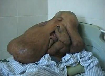 malformation, maladie rare, elephant man, insolite, opération, homme difforme, vidéo, buzz, incroyable,