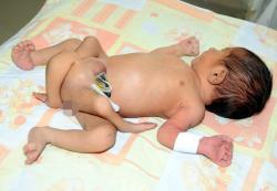 bébé avec 6 jambes, Pakistan, insolite, médecins, opération chirurgicale, retirer les membres, exposé, rayons X, malformation, jumeau parasite,