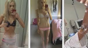 Elle lietzow incroyable transformation alimentaires maigre grosse malaises convulsions maladie anorexie fille personne boulimie vomir