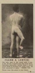 homme aux 3 jambes, Francesco Lentini, insolite, Sicile, attachée, colonne vertébrale, malformation, jumeau parasite, ventre de sa mère, abandonné, rejeté, traité de monstre,