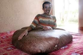 souffrance, tumeur de 80 kg, insolite, Duy Hai, vidéo, à la jambe, développée, après sa naissance, amputation, opération, échoué,