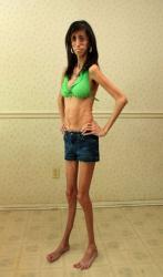 femme, plus maigre, du monde, insolite, maladie, très rare, Lizzie Velasquez, 60 repas par jour, nourriture, 30 kg, bonne santé, pas anorexique,