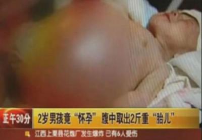 bébé de deux ans, accouche de son frère, insolite, jumeau, en Chine, rarissime, peine croyable, radios, corps médical, opération, Xia Feng,