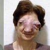 tumeur de la face, insolite, rare, Chantal Sébire, médiatisation, souffrances, décès, sinus, cloison nasale, l’euthanasie, esthésioneuroblastome,