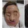 défigurée, chimpanzé, Charla Nash, visage, insolite, fou, vécu cachée, greffe, spectaculaire, derrière un voile, violence sauvage, animal domestique, particulier, antidépresseurs, 