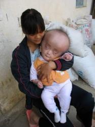 bébé chinois, souffre, mystérieuse, maladie rare, insolite, volume de son crâne, ne cesse de croître, Hong Yu, fièvre, médecins,