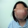 tumeur, incroyable, insolite, déformation, visage, Wu Xiaoyan, avatar girl, appel à l'aide, financer, traitement, James Cameron, soigner, chimiothérapie, radiothérapie,